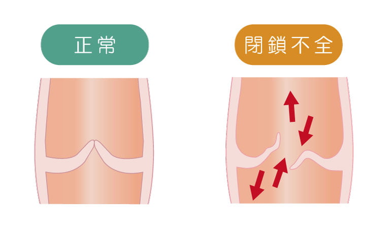 閉鎖不全（へいさふぜん）