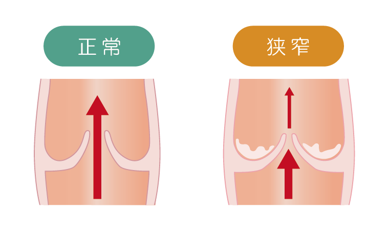 狭窄（きょうさく）